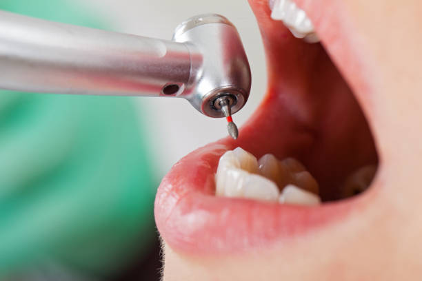 Best Emergency Dental Care for Broken or Chipped Teeth in Pine Island, TX